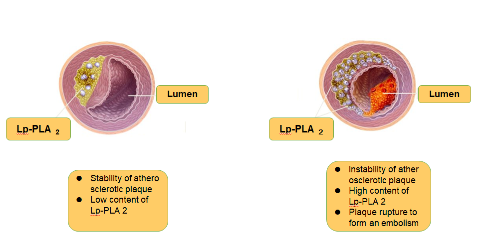 1645689930462548.png Schematic diagram of Lp-PLA2 and plaque stability 1.png